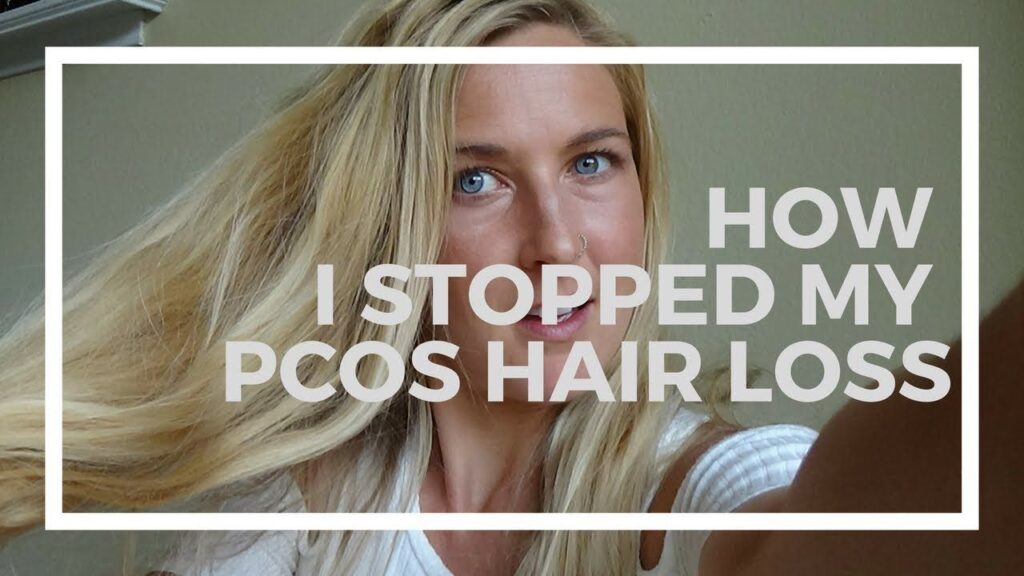 Can Hair Loss Due To PCOS Be Reversed?