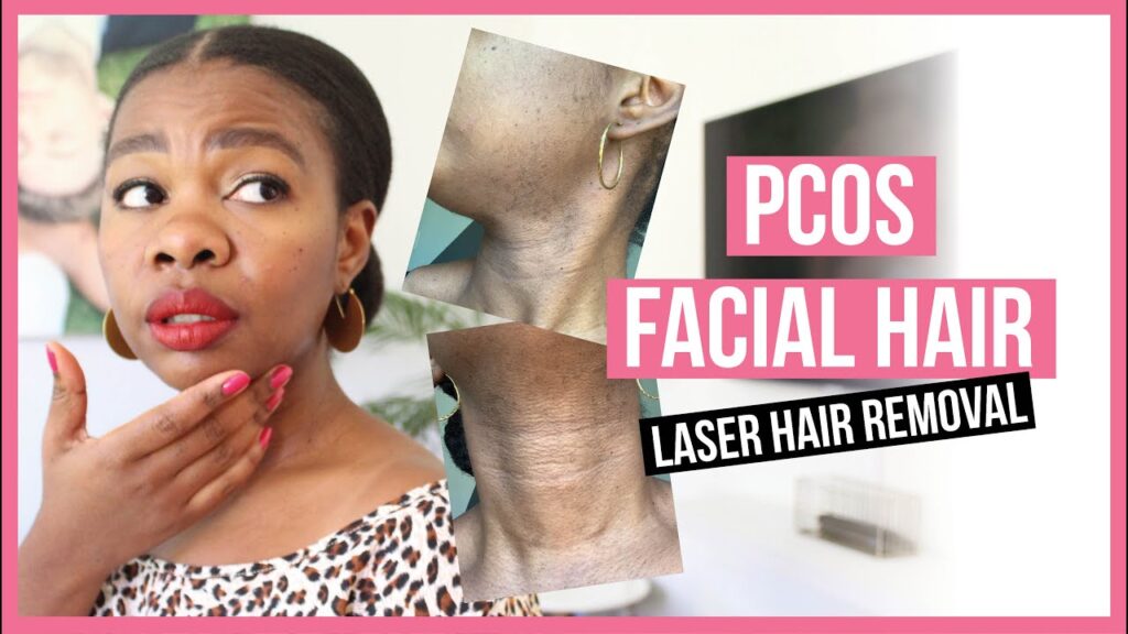 Can you reverse PCOS facial hair?
