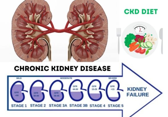 CKD DIET