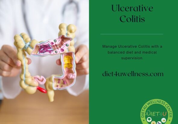 Ulcerative Colitis